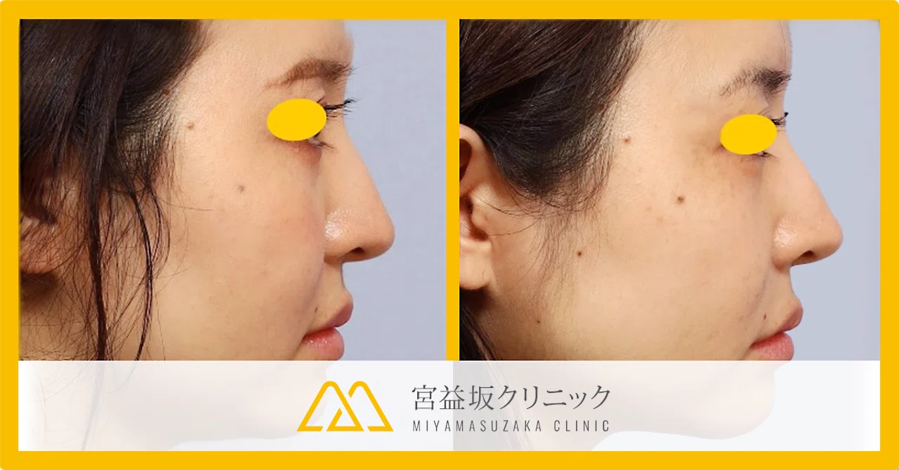 鼻翼基部プロテーゼ ~横顔に自信のない方や小鼻横のくぼみが気になる方へ~|宮益坂クリニック【院長青井の症例ブログ】
