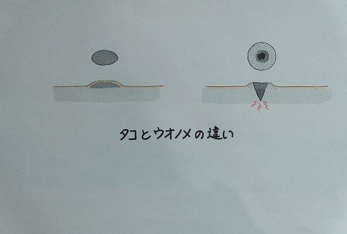 ウオノメの痛みを緩和する靴選びは 岐阜の上級シューフィッター夫婦が贈るシアワセノクツblog Note ウオノメの痛みを緩和する靴選びは 岐阜の上級シューフィッター夫婦が贈るシアワセノクツblog Note