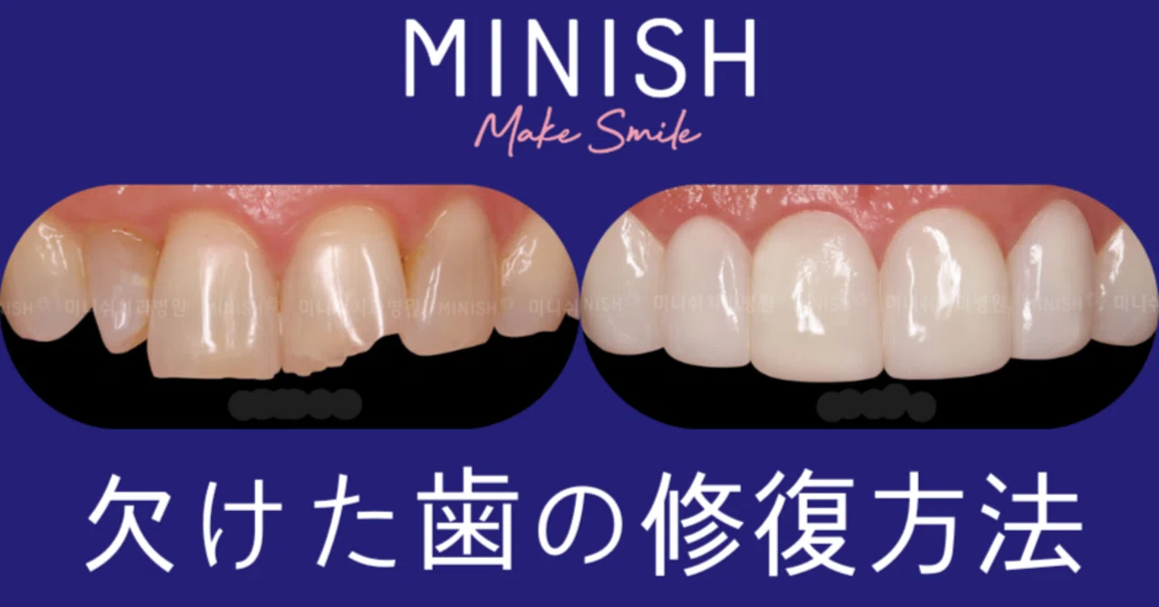予想外の事故から永久歯を守る方法 ～欠けた歯～｜ミニッシュJAPAN