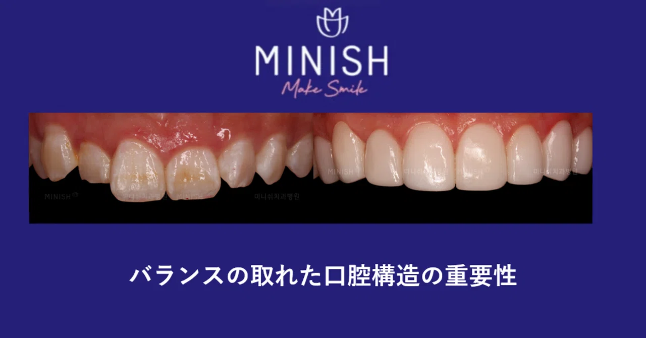 バランスの取れた口腔構造の重要性 - 捻転歯‐｜ミニッシュJAPAN