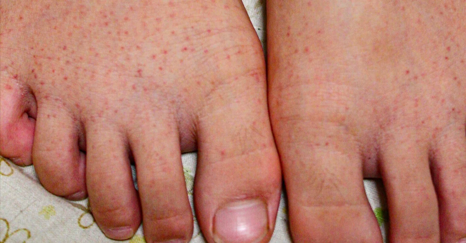 iga 血管 炎