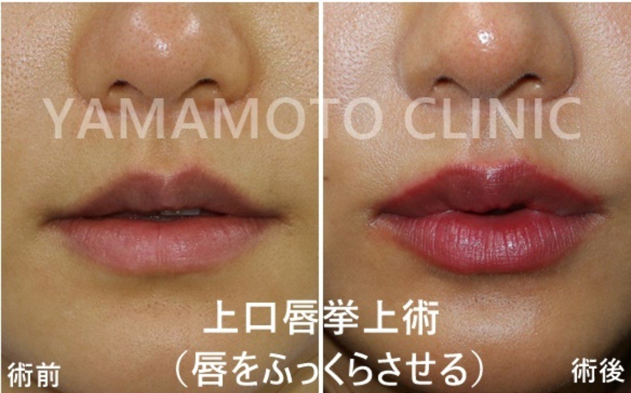唇をふっくらさせる方法があります 新宿 山本クリニック Note 唇をふっくらさせる方法があります 新宿 山本クリニック Note