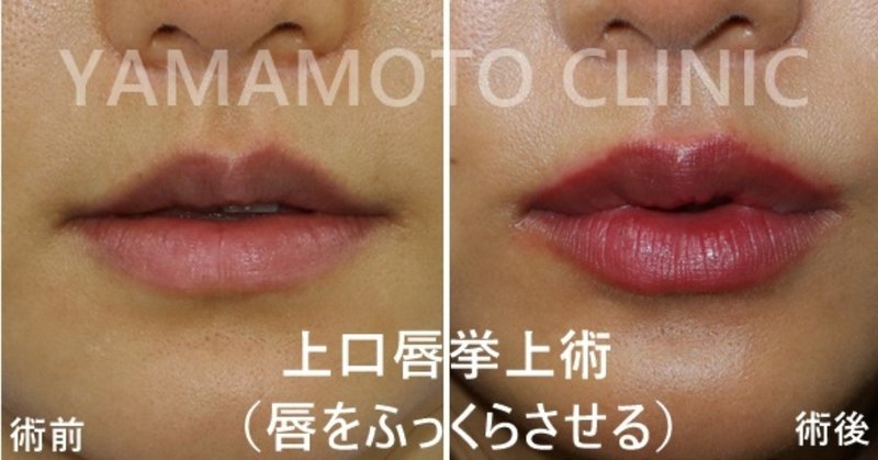 唇をふっくらさせる方法があります 新宿 山本クリニック Note