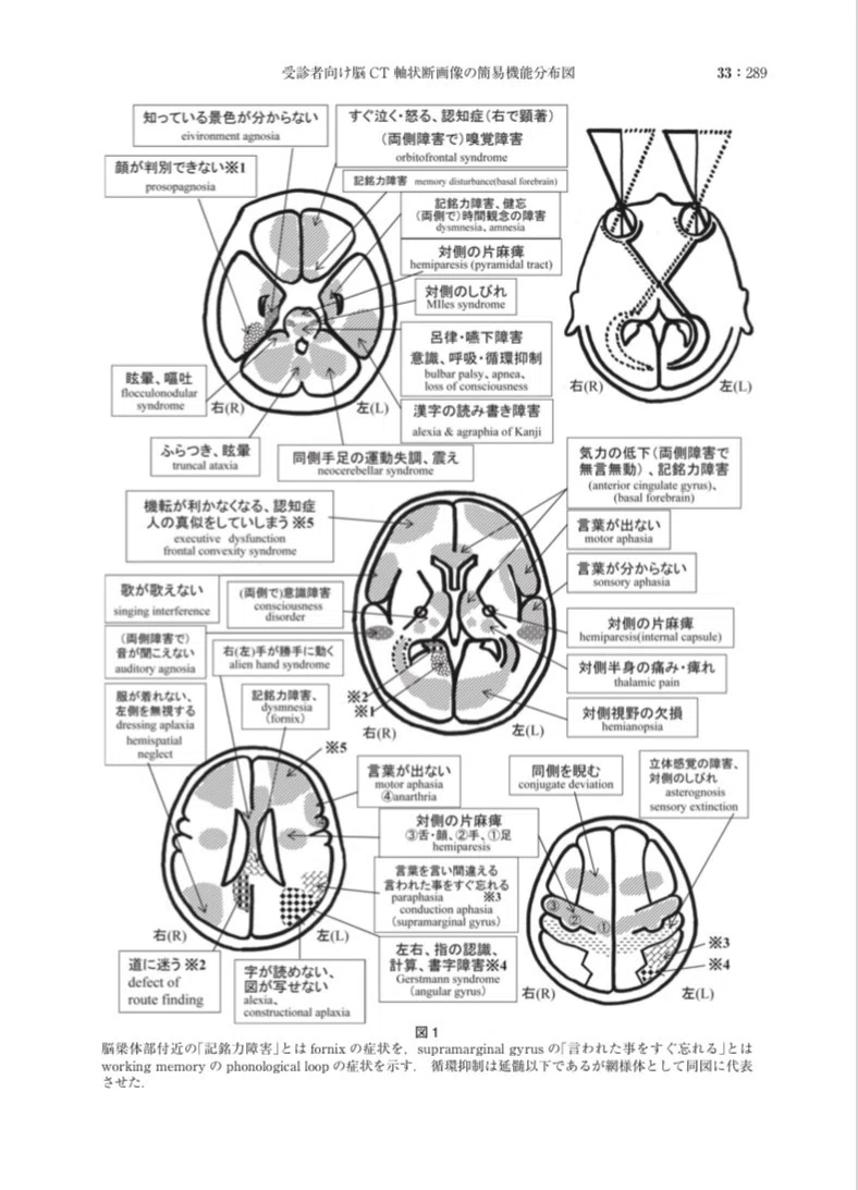 僕が知る限り一番簡単でわかりやすい脳画像の読み方｜サンダー・謙虚