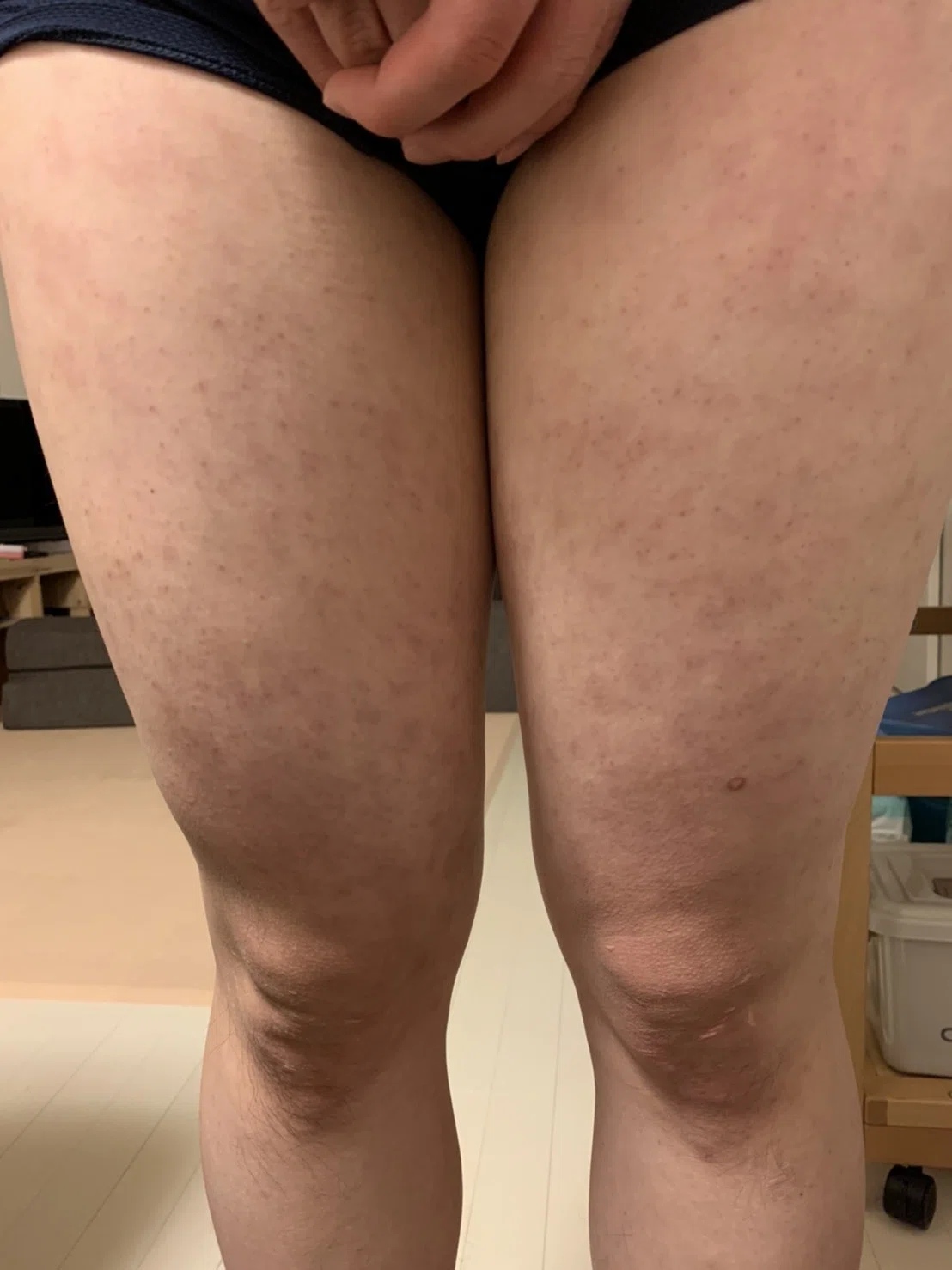 ピロリ菌の除菌薬でアレルギー反応（薬疹）でて２ヶ月経過した身体を 