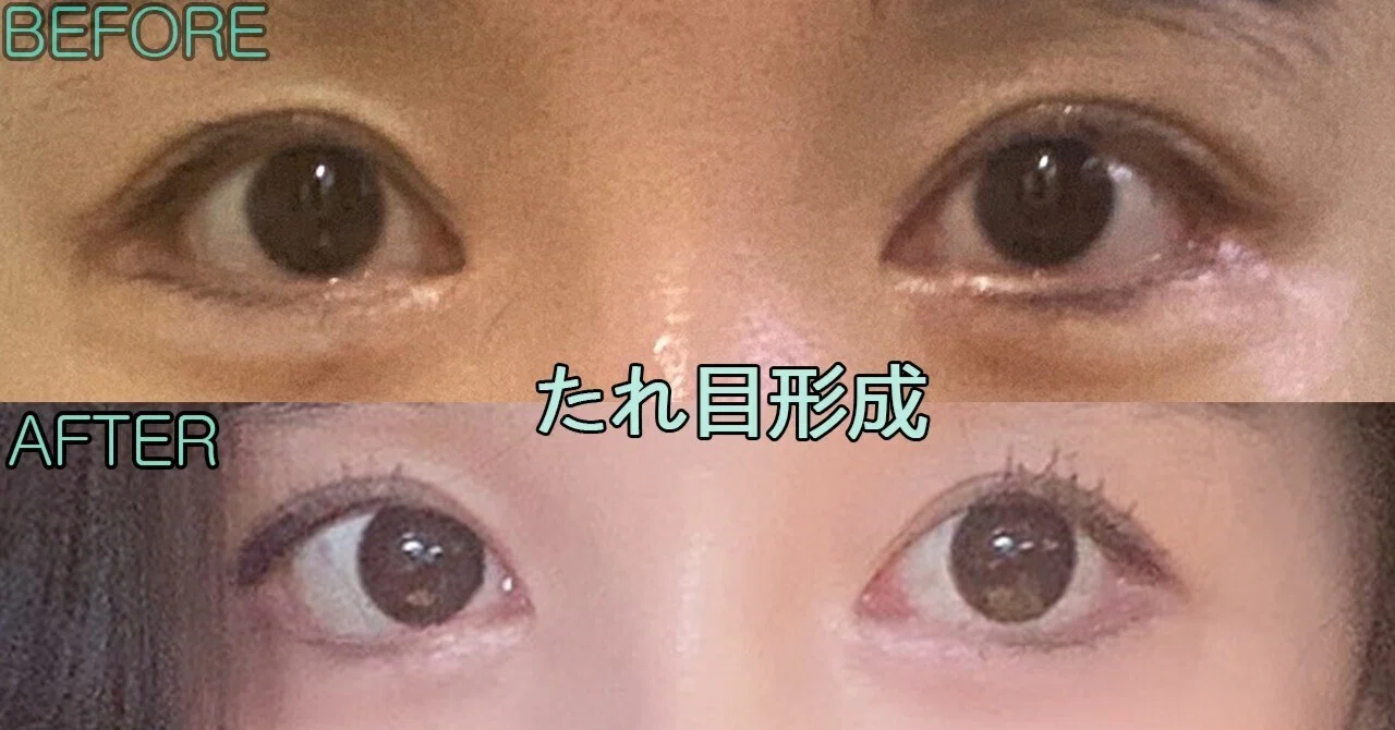 たれ目形成手術をしました。|라리성형외과 ラリ美容外科
