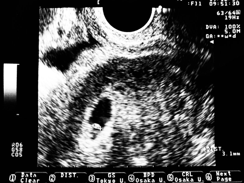 心拍確認 Az 40歳からの不妊治療 Note