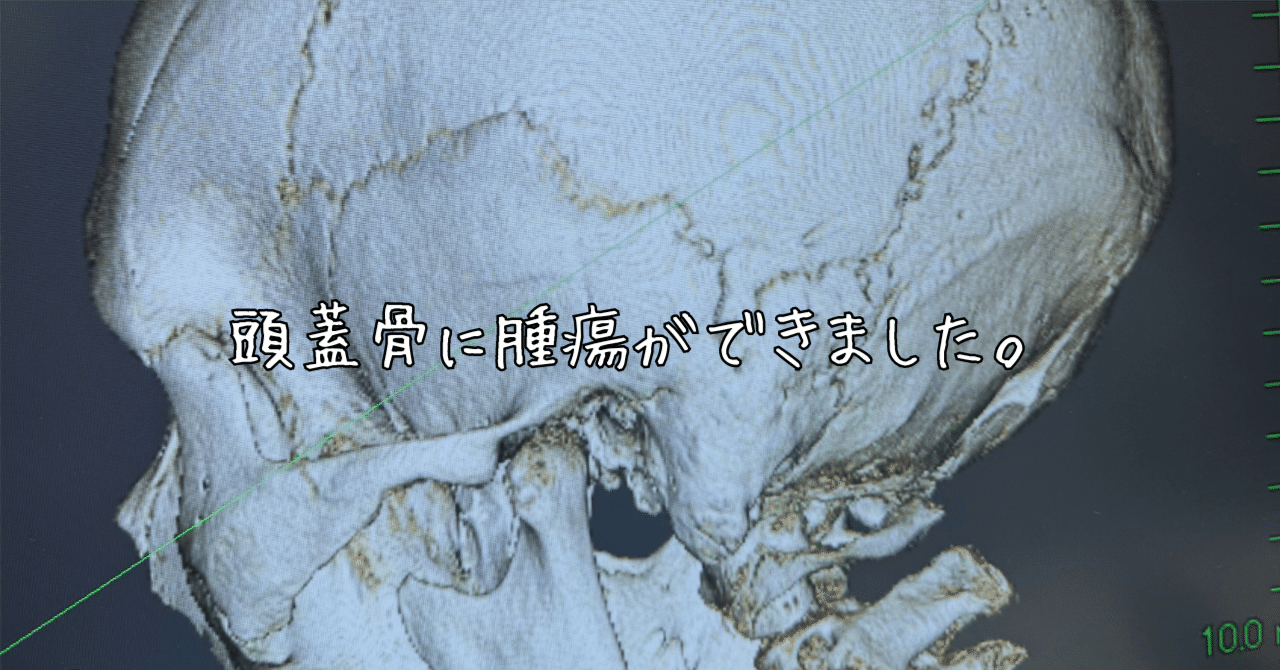 頭蓋底腫瘍　裁断済み 良性腫瘍・頭蓋底腫瘍 | 横浜市立大学附属 市民総合医療センター