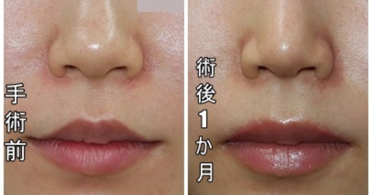 鼻尖形成と上口唇挙上術 外側人中短縮 の変化はどのくらい 新宿 山本クリニック Note