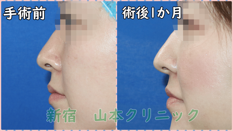 小鼻縮小術で鼻の穴も見えにくくする 新宿 山本クリニック Note