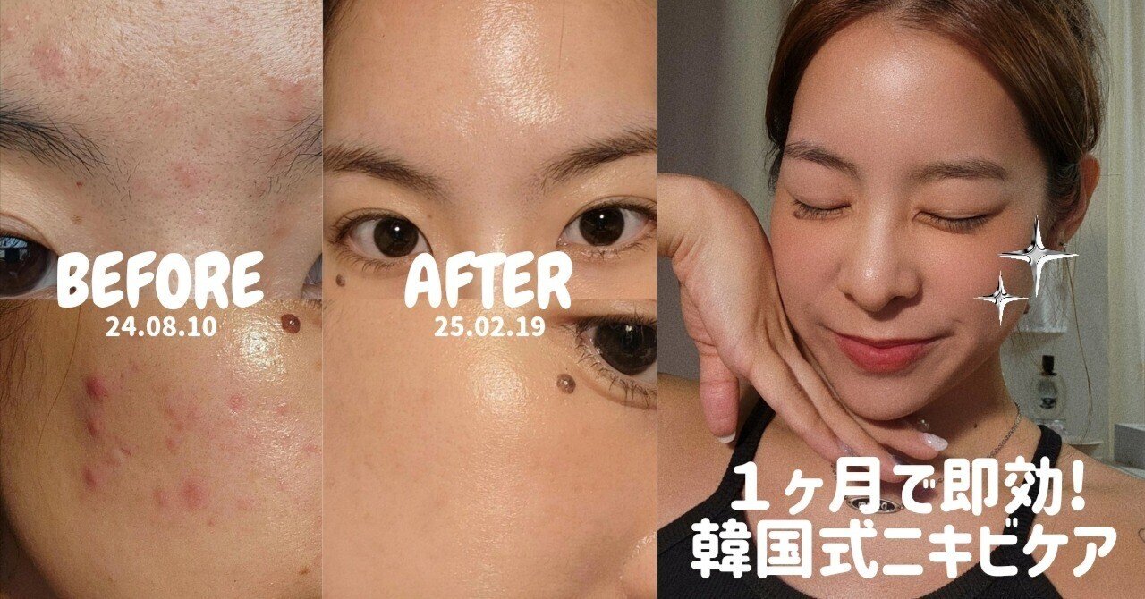 1ヵ月でニキビ肌卒業!誰でもできる『韓国式パデプリ』ニキビケア