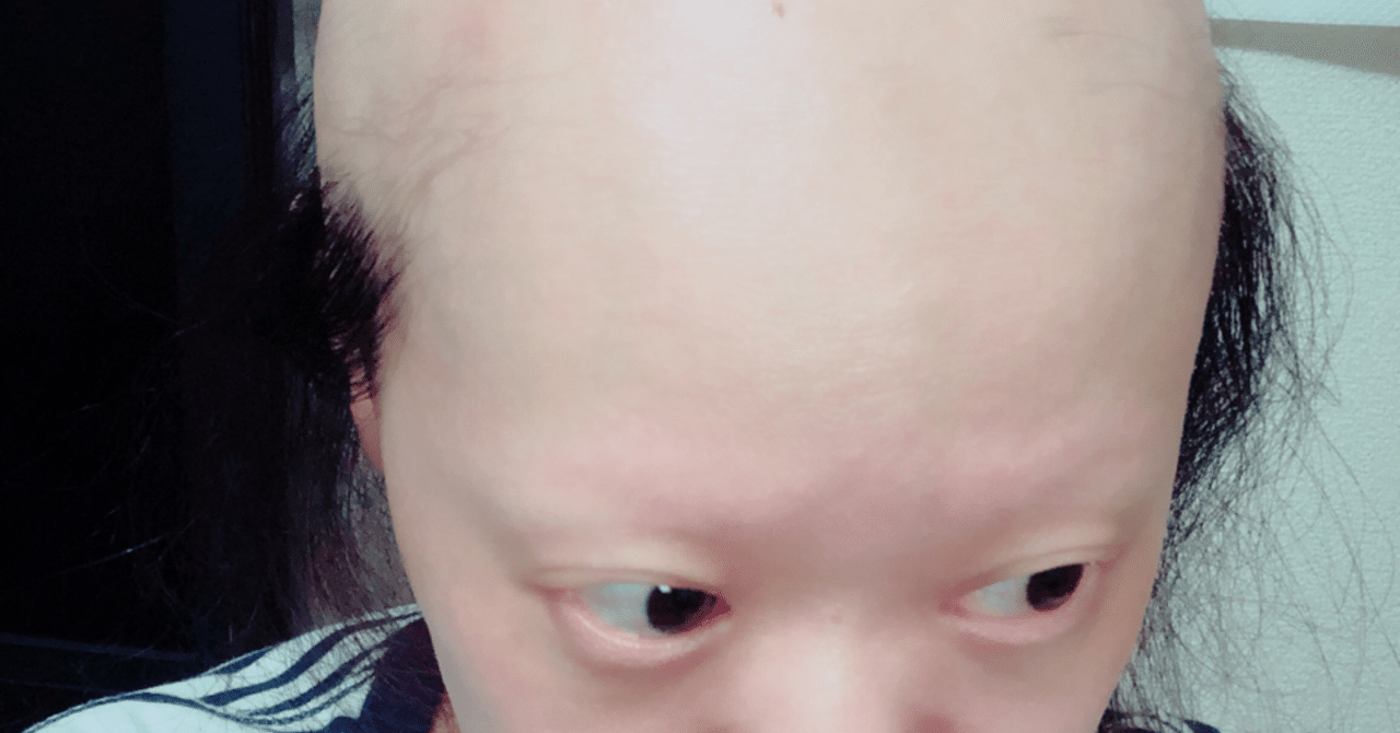 全身脱毛症になった自分の話