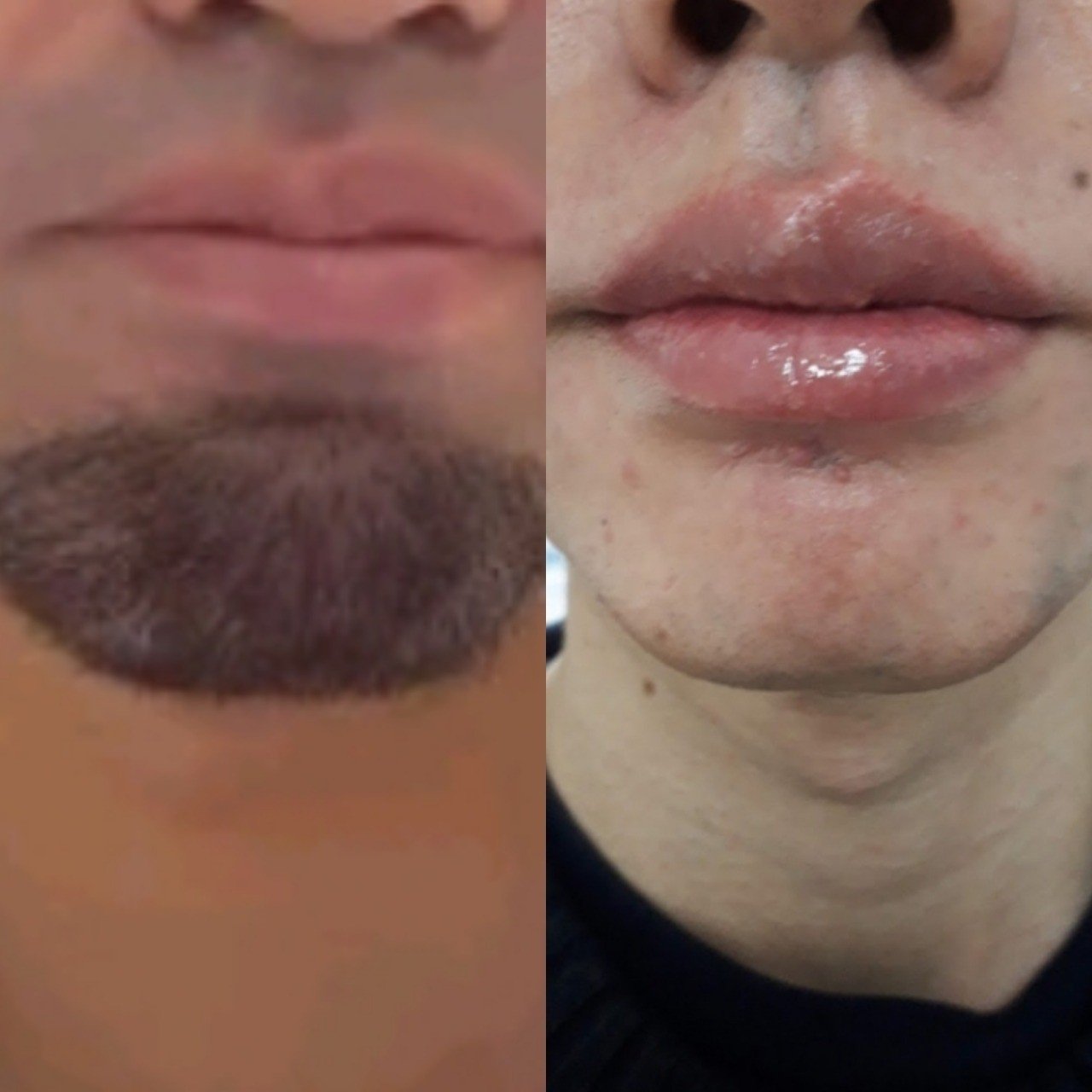 ヒゲの92 がツルツルになった 2年間のヒゲのレーザー脱毛の記録写真集 日本ハゲかけ協会会長 Note