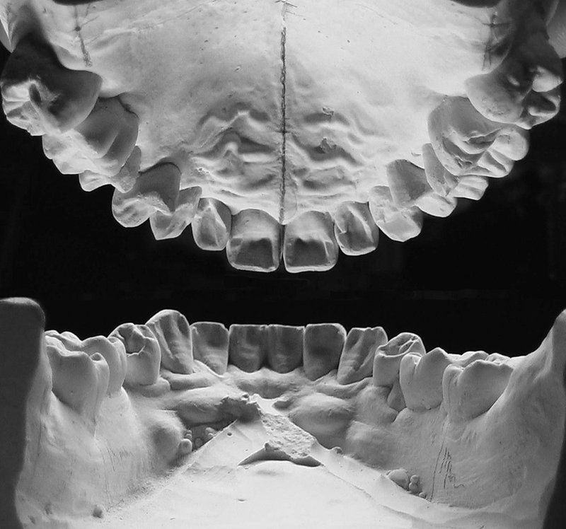 右側偏位歯牙大きめ(32)