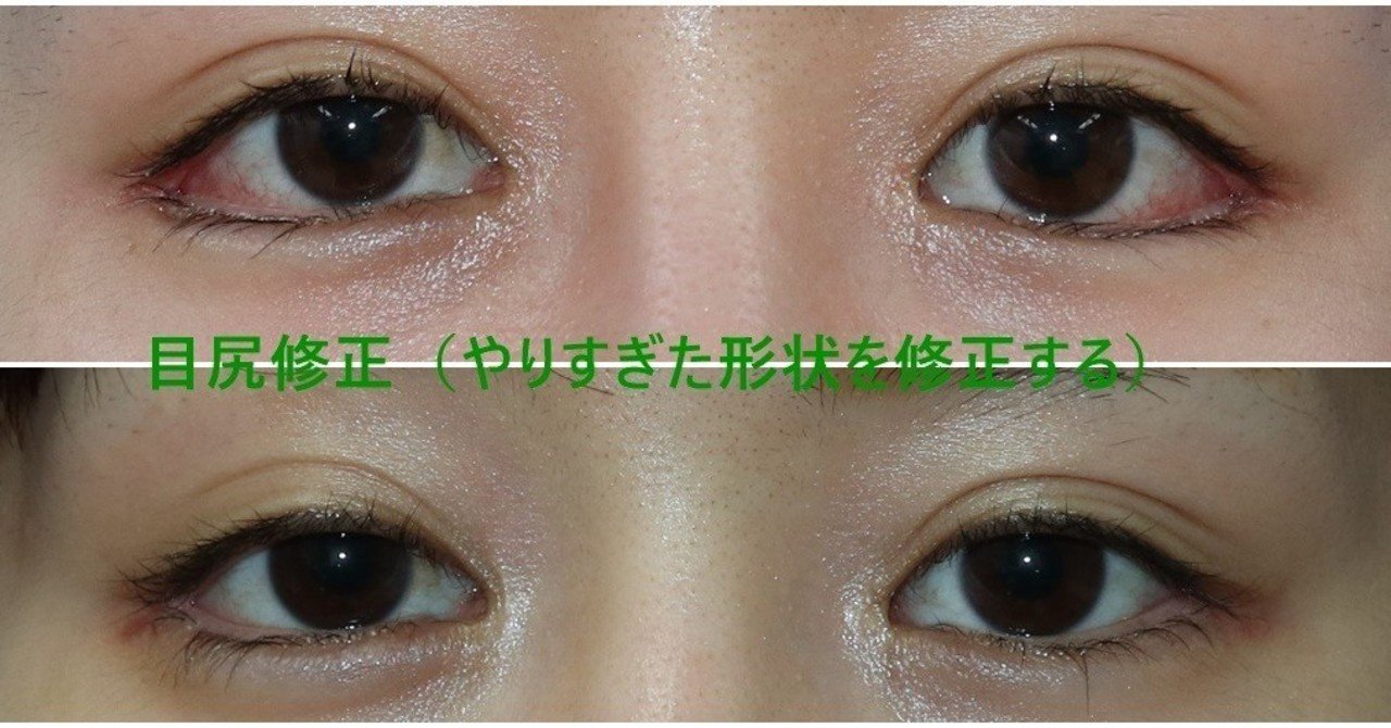 目尻切開のやりすぎ注意 新宿 山本クリニック Note