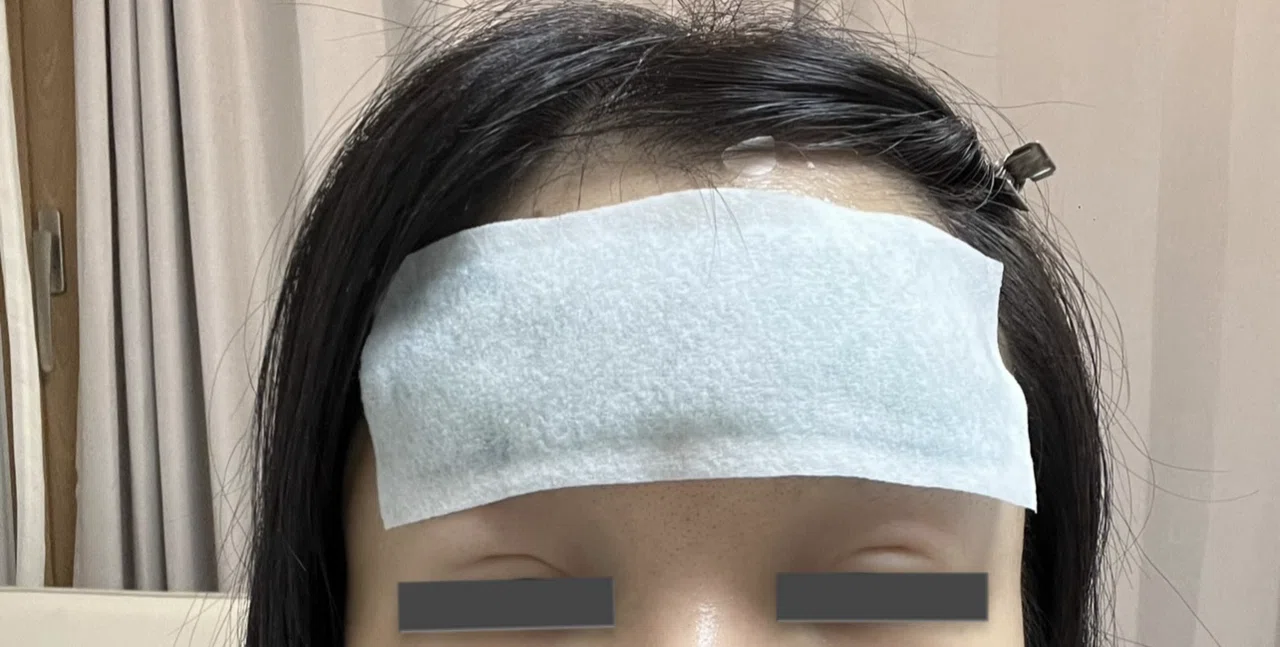 💥 I underestimated the forehead filler downtime... A report on my 3 ...
