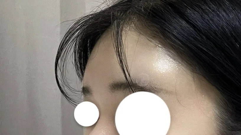 💥 I underestimated the forehead filler downtime... A report on my 3 ...