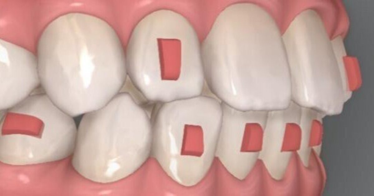 【新品】歯科　invisalign アライナー　患者説明用模型 新品】歯科 invisalign アライナー 患者説明用模型