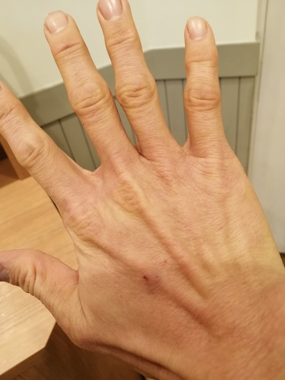 アトピー日記 132日目 眉間が死ぬほどかゆい アトピーマン Note