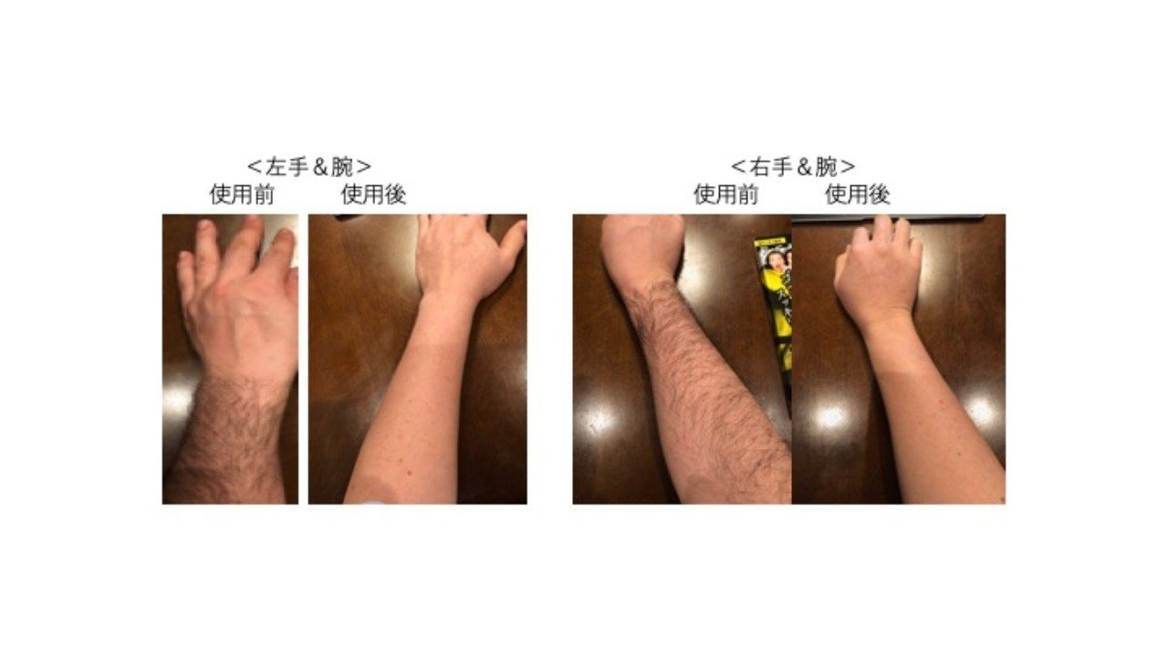 ブラジリアンワックス 両腕やってみた スベスベでスッキリ万歳 一人十色 Note ブラジリアンワックス 両腕やってみた スベスベでスッキリ万歳 一人十色 Note