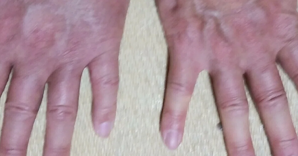 My little finger has shrunk｜アト