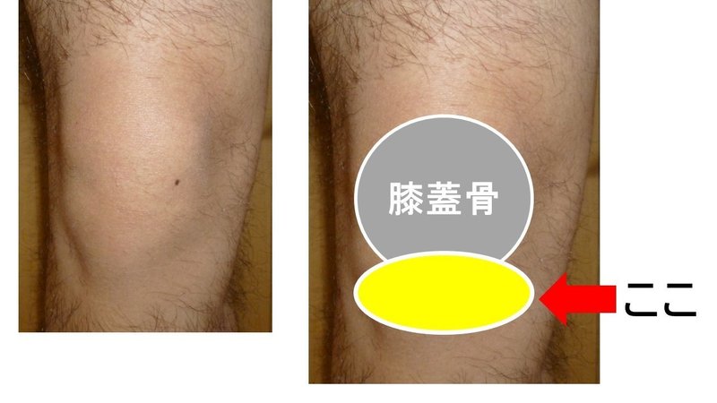 膝痛や可動域制限の原因 膝蓋下脂肪体の評価 アプローチまで解説 おっしー 理学療法士note Note