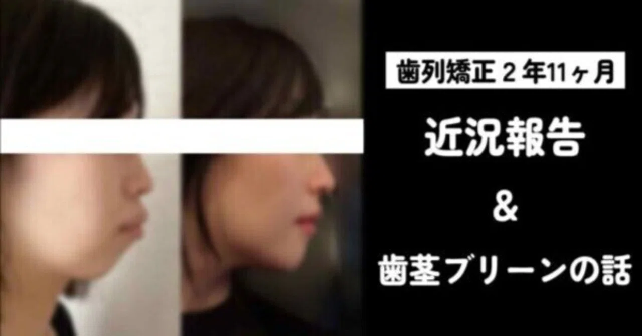 歯列矯正㉑】2年11ヶ月経過報告。ガミースマイルの話。｜Midori｜歯列