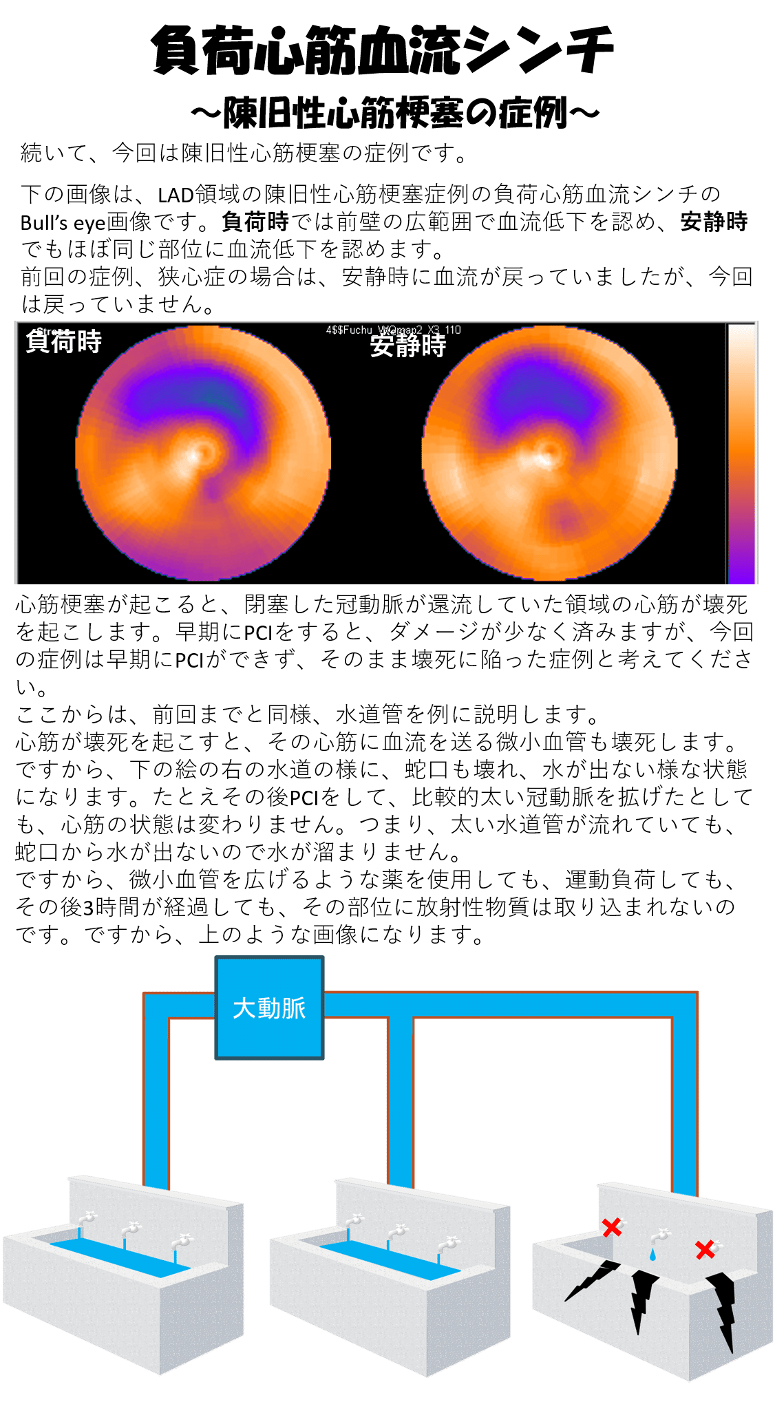 旧 梗塞 心筋 陳 性 心筋梗塞予後の注意点と再発予防策