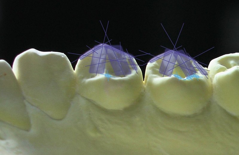 下顎右側小臼歯形態No2WEB6