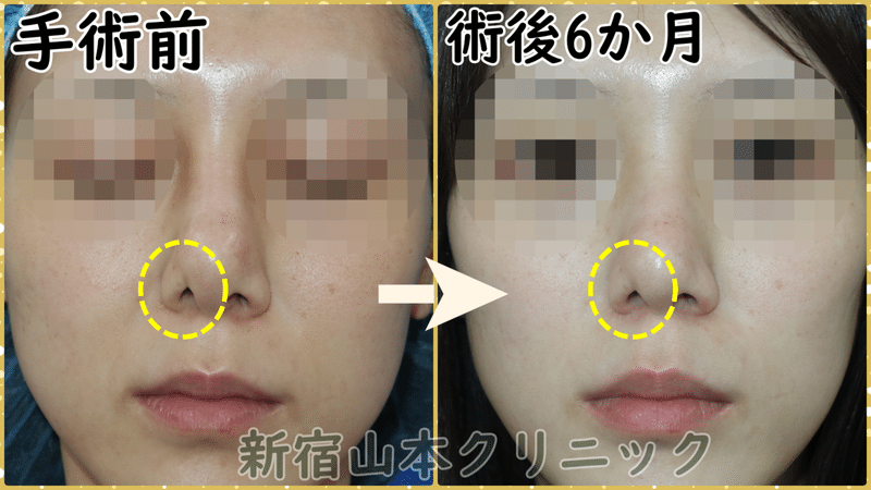 シリコン隆鼻で鼻の穴が崩れる 新宿 山本クリニック Note