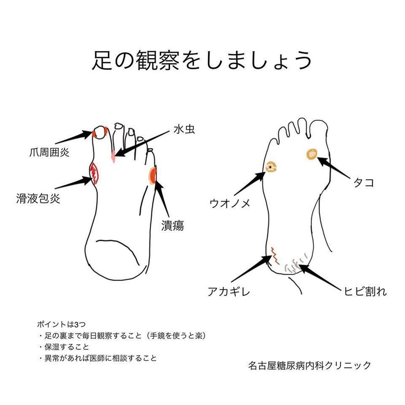 フットケアについて|名古屋糖尿病内科クリニック|note フットケアについて|名古屋糖尿病内科クリニック|note