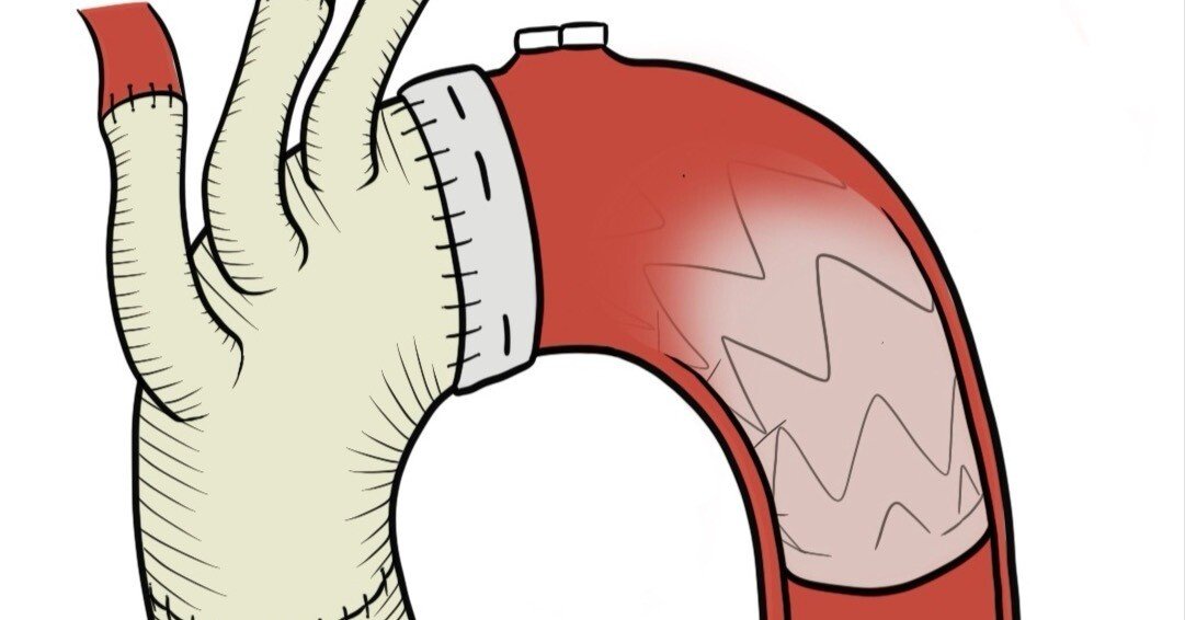 症例イラスト紹介】急性大動脈解離のその後──解離性大動脈瘤手術と