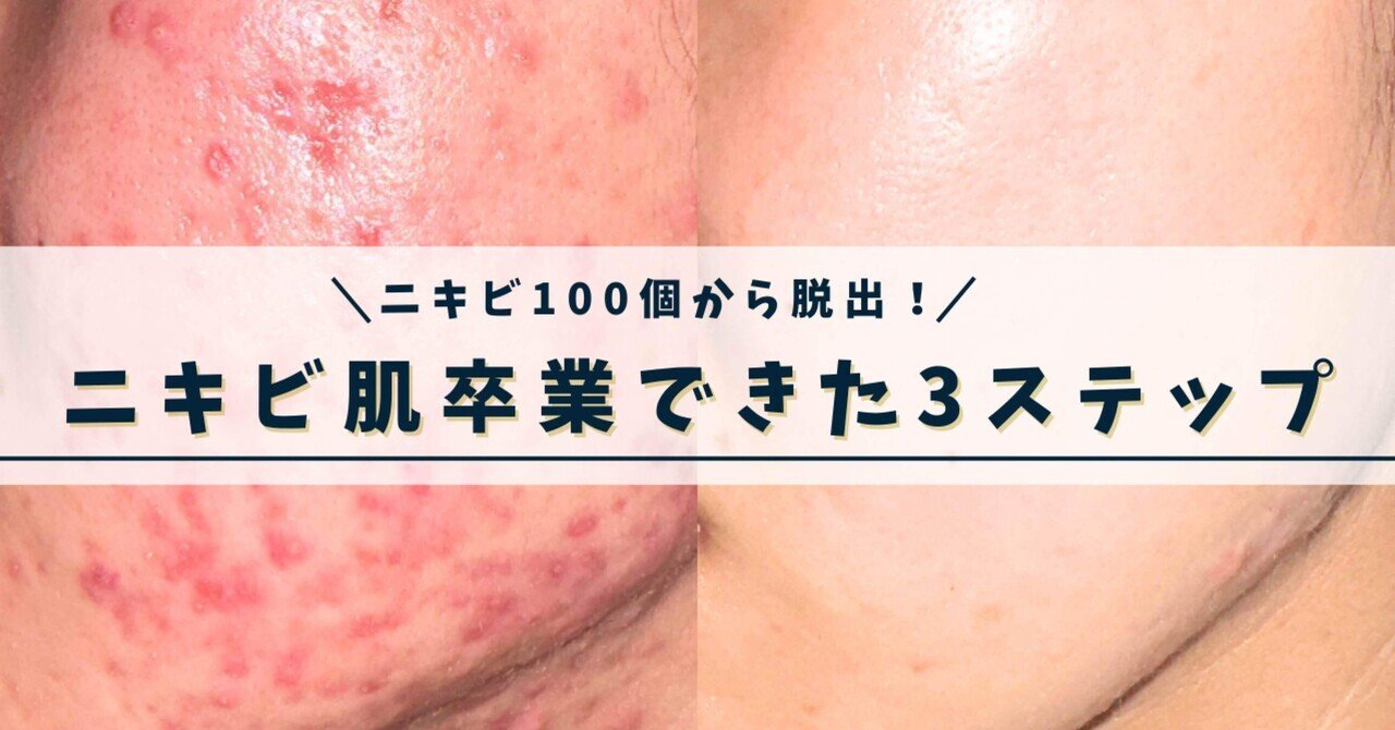 美容レビュー】ニキビ肌を卒業できた3つのステップ✨🥰｜RERE