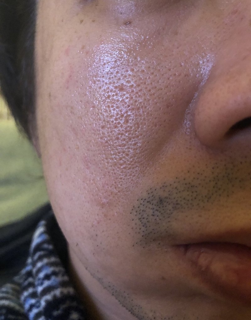 にきび跡 クレーター 毛穴の開きってこんなに治る ニキビ跡 毛穴悩み歴10年 30歳の逆転サラリーマン Note