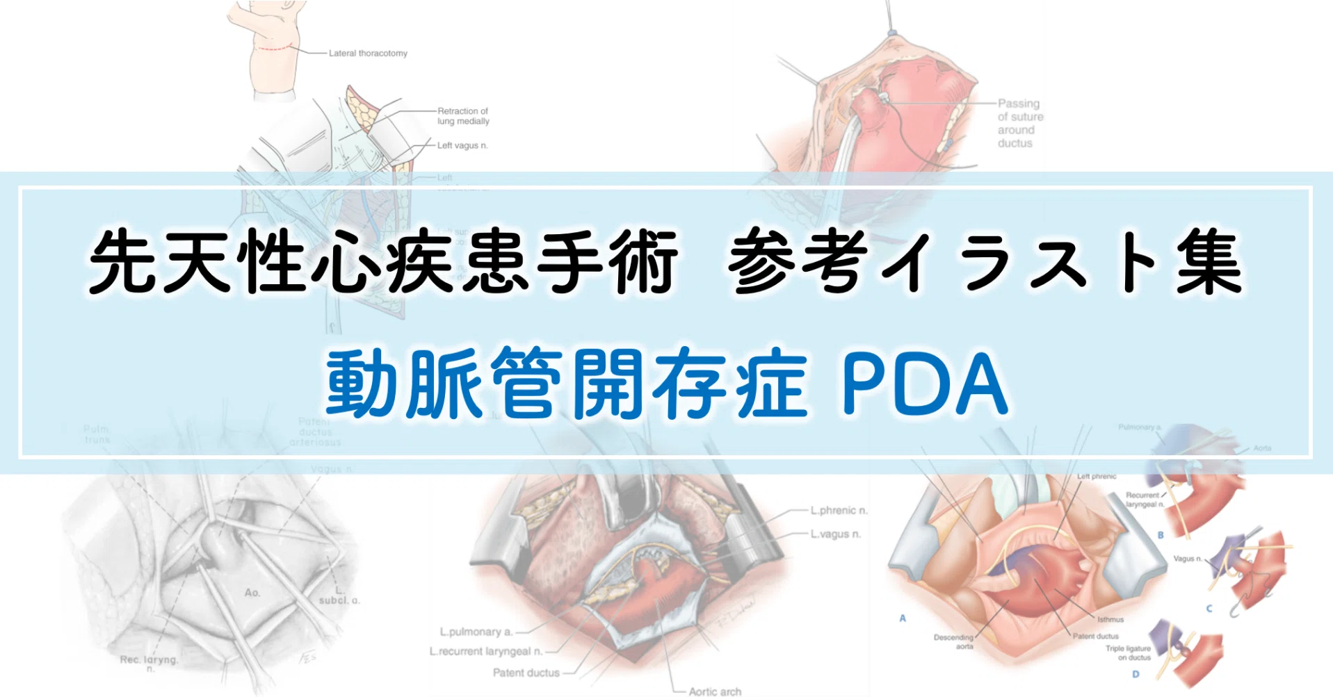 先天性心疾患手術：参考イラスト集》 動脈管開存症 （左側開胸）｜た
