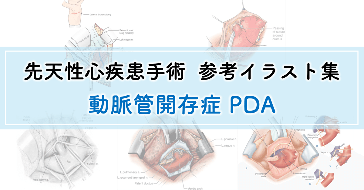 イラストでわかる実施困難症例の大動脈ステントグラフト Visualizatio… 81WEO1ewCTL.jpg