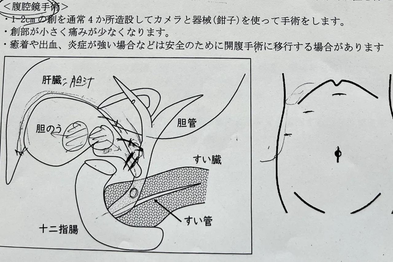 胆嚢 摘出 後 痛み いつまで