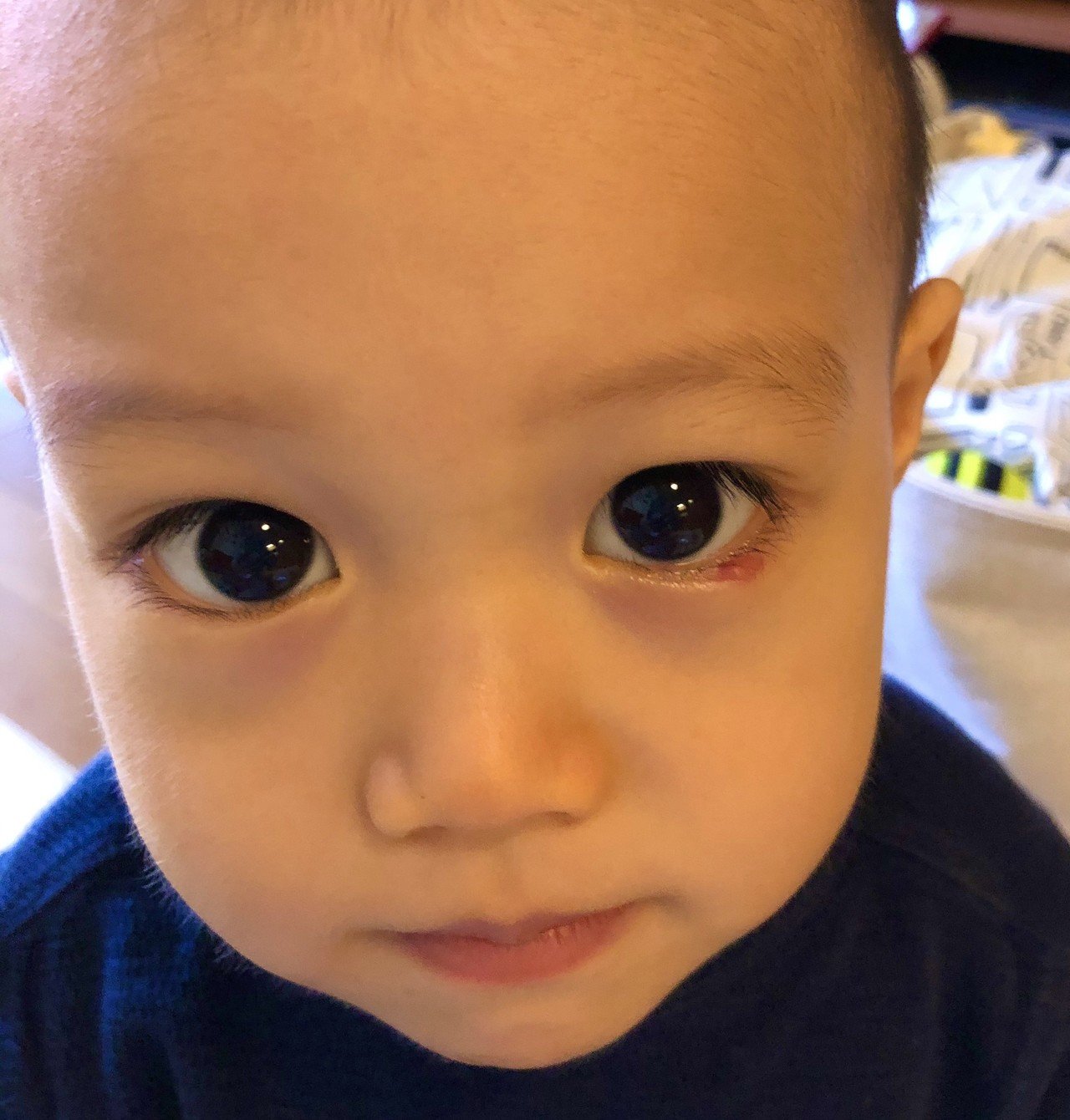 2歳4ヶ月の霰粒腫 無麻酔での切開手術 片寄明人 Note 2歳4ヶ月の霰粒腫 無麻酔での切開手術 片寄明人 Note