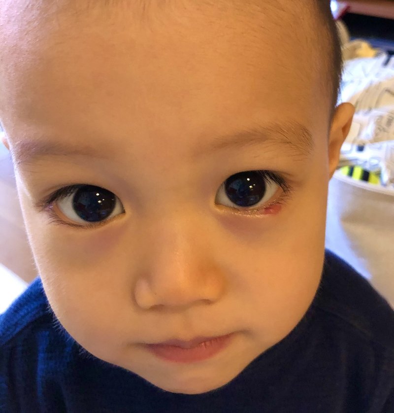 2歳4ヶ月の霰粒腫 無麻酔での切開手術 片寄明人 Note 2歳4ヶ月の霰粒腫 無麻酔での切開手術 片寄明人 Note