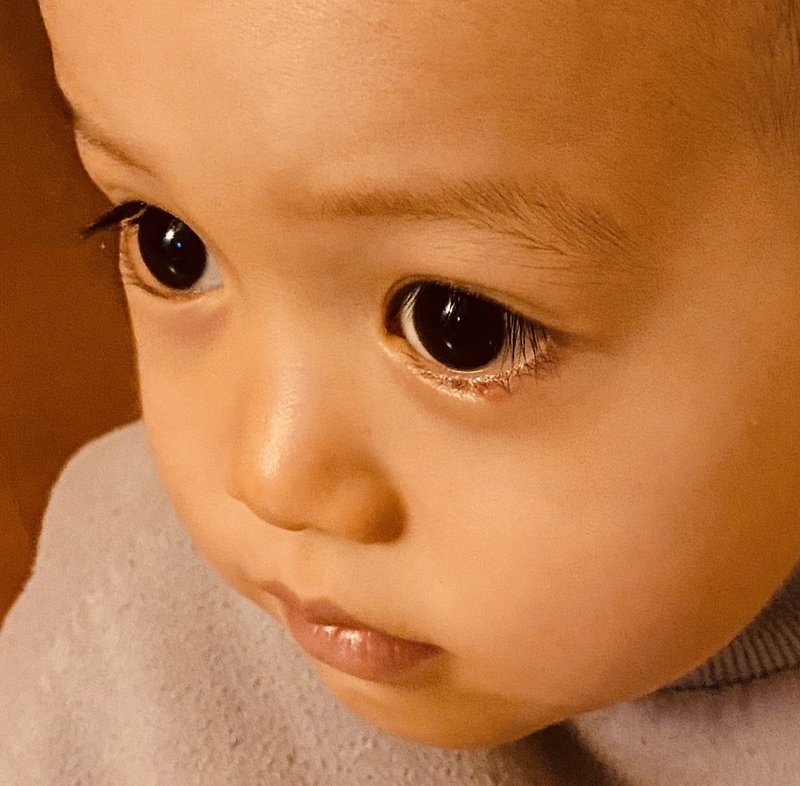 ２歳４ヶ月の霰粒腫 無麻酔での切開手術 片寄明人 Note