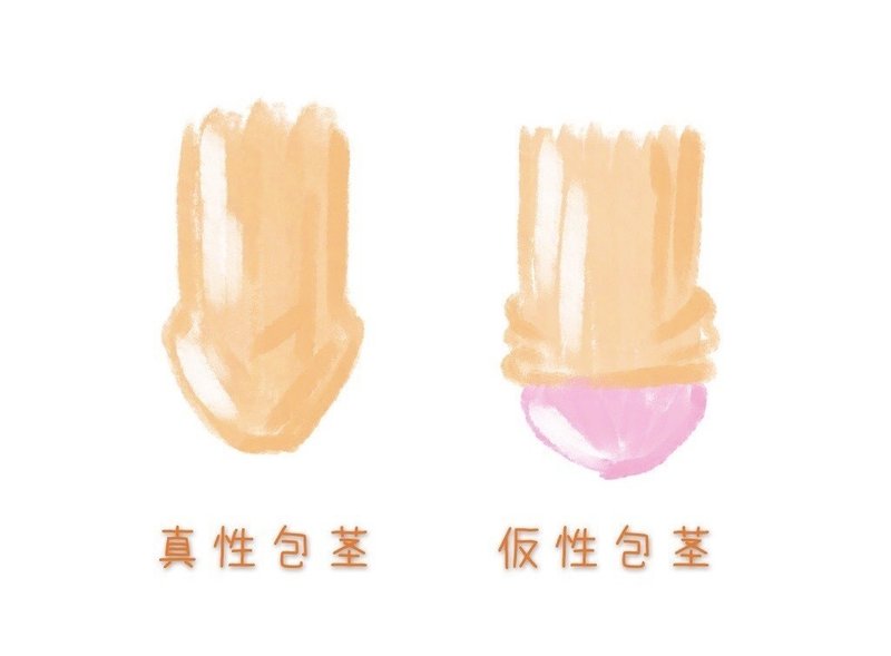 包茎 どこから手術が必要 乙供 太郎 Agクリニック銀座 院長 Note 包茎 どこから手術が必要 乙供 太郎 Agクリニック銀座 院長 Note