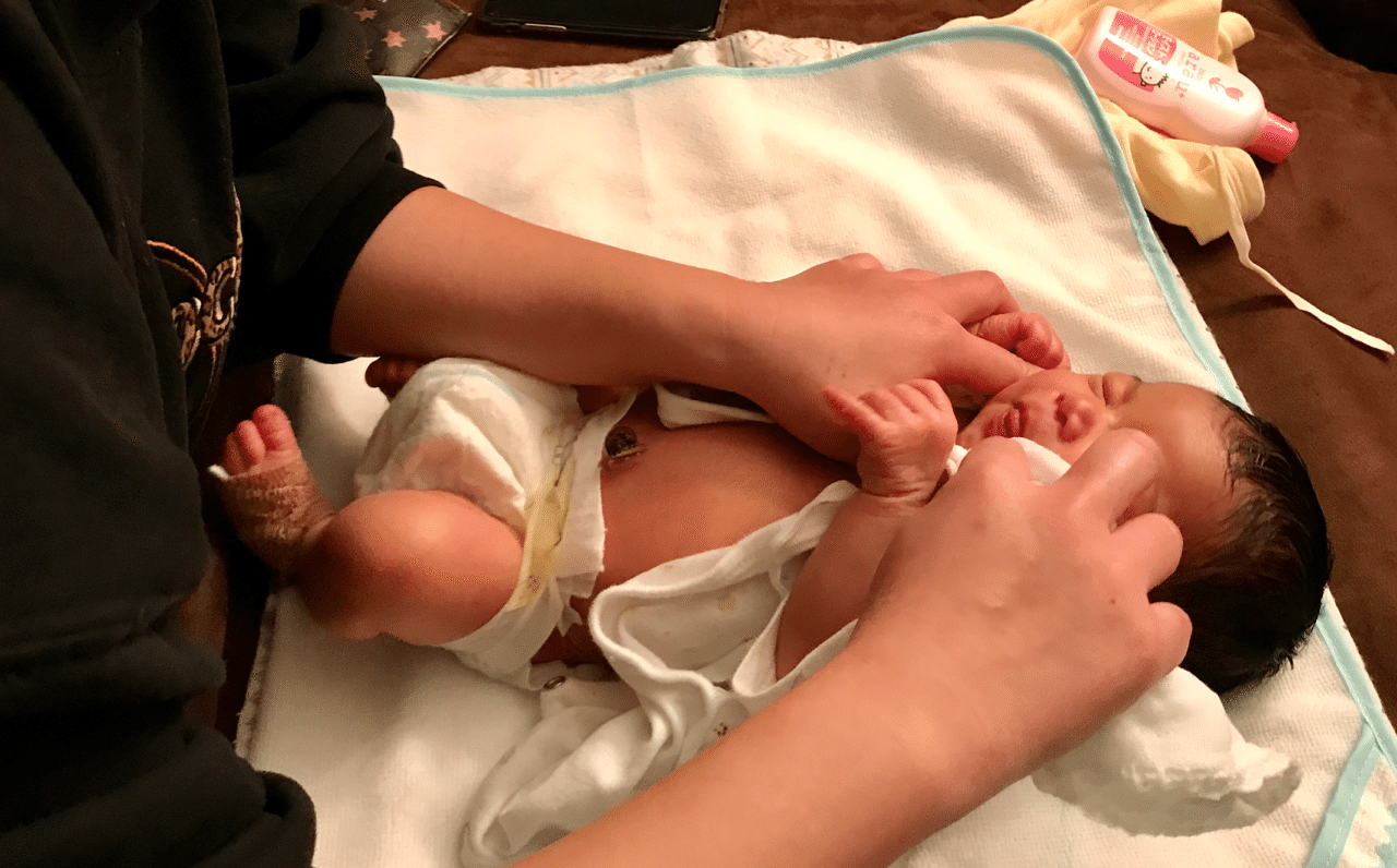 蒙古斑がある 新生児黄疸について よーこさん Note
