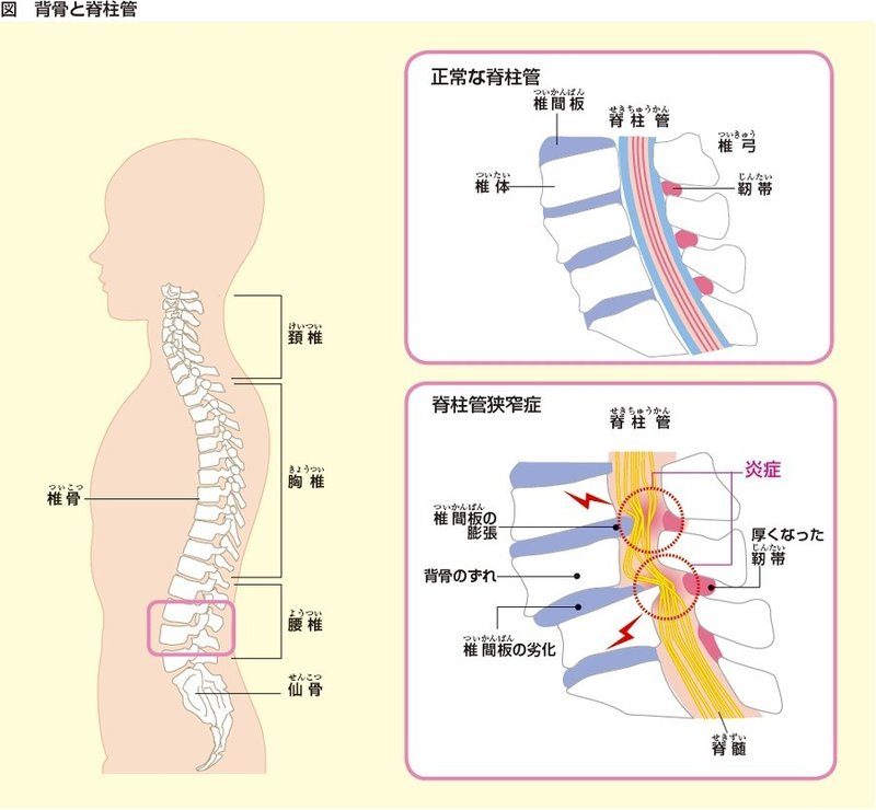 腰部脊柱管狭窄症 Tamg0124 Office Tamura Note