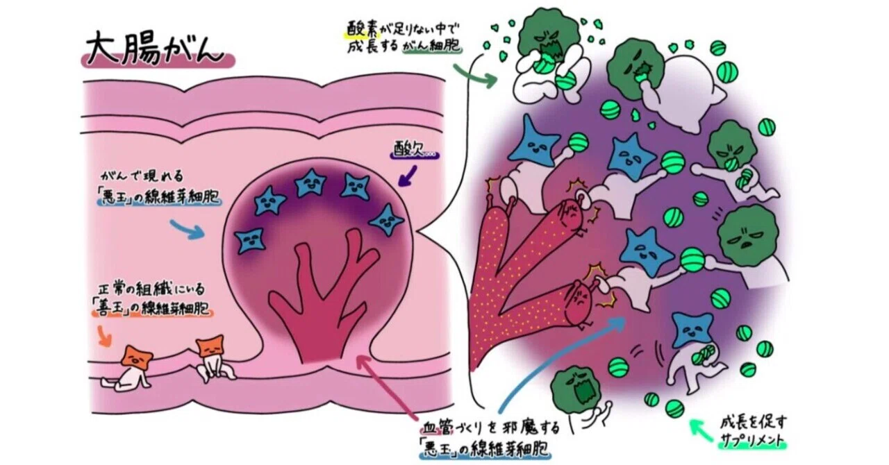 最新｜部分的な酸欠状態が、大腸がんを悪性化させる