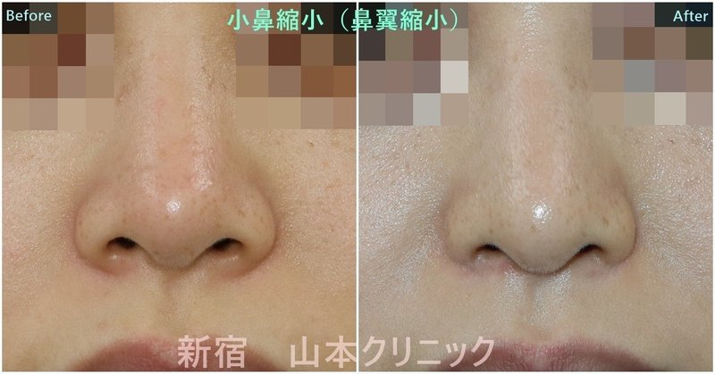 他とは違う 鼻整形 小鼻縮小 鼻翼縮小 新宿 山本クリニック Note