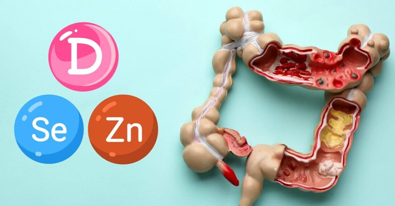 炎症性腸疾患患者におけるビタミンD、亜鉛、セレン欠乏の危険因子
