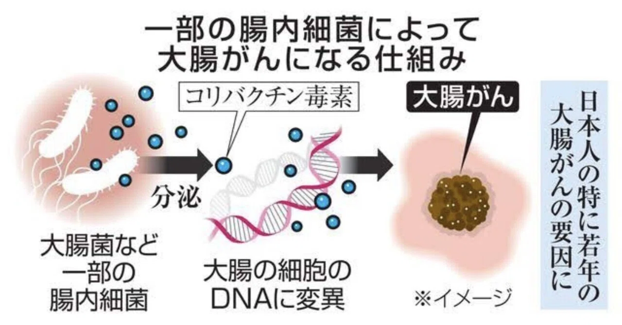 最新｜日本人大腸がん患者さんの5割に特徴的な腸内細菌による発がん要因を発見