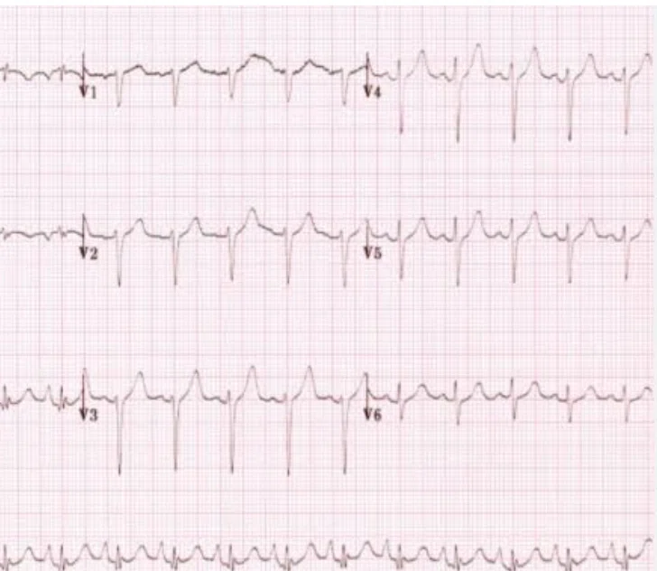 [ECG Beginner] 