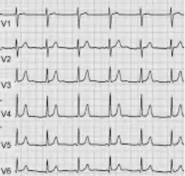 [ECG Beginner] 
