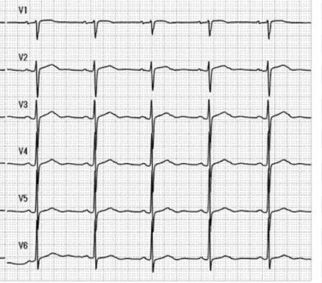 [ECG Beginner] 